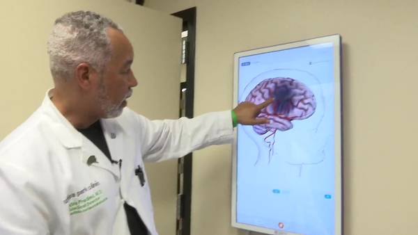 Video: Doctors see increase in Large Vessel strokes in people under the age of 50