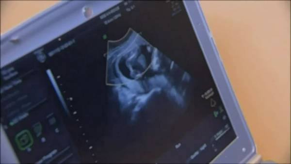 Some physicians concerned about gray area caused by new abortion trigger laws